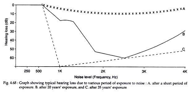 Typical Hearing Loss