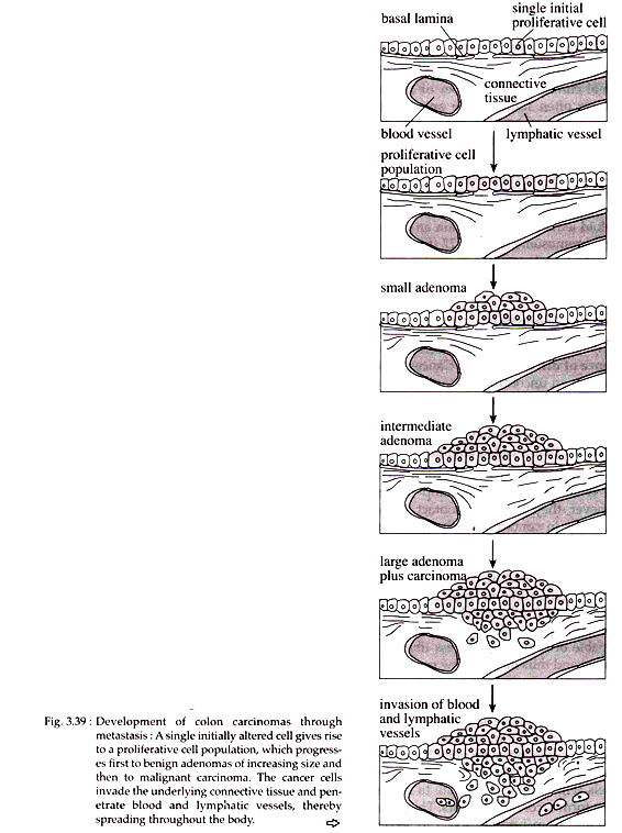 Development of Colon Carcinomas