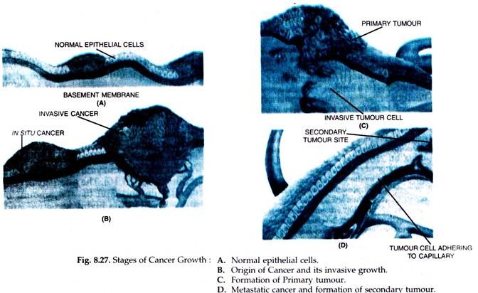 Stages of Cancer Growth