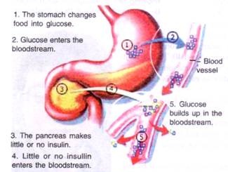 Diabetes mellitus