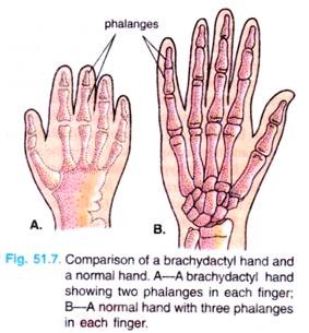 Comparison of a brachydactyl  hand and a normal hand